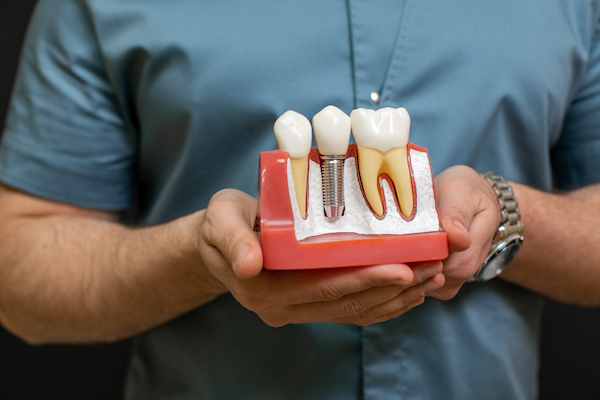 benefits of dental implants gordon