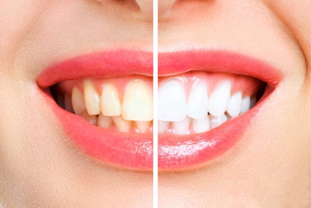 7 reasons why you should undergo teeth whitening
