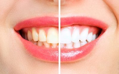 7 Reasons Why You Should Undergo Teeth Whitening