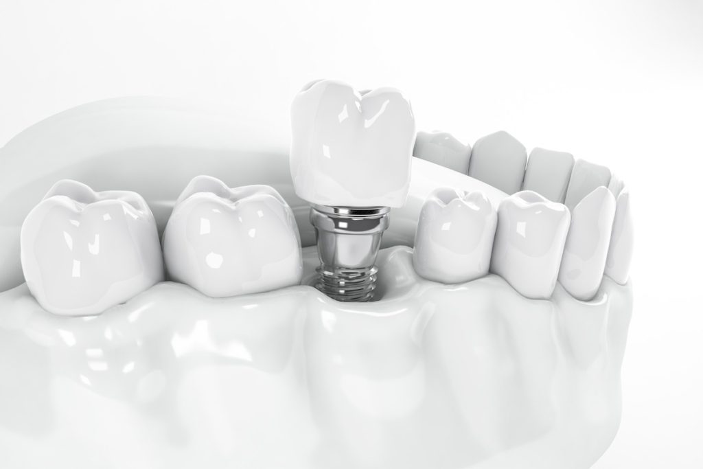 are dental implants the long-term solutions