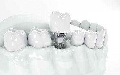 Are Dental Implants the Long-term Solutions to Your Missing Teeth?
