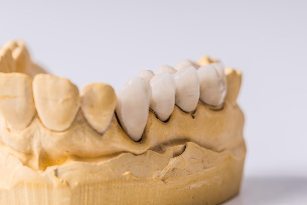 dental crowns vs bridges comparing different restorative options