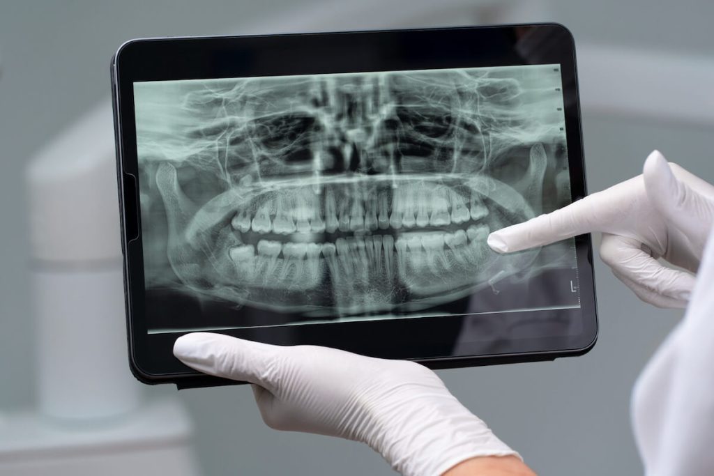 why timing matters for bone grafting