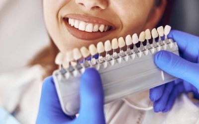 How Long Do Veneers Last, and What Affects Their Longevity?