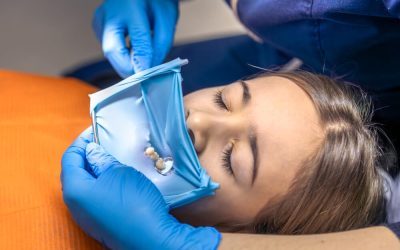 How Fissure Seals Protect Teeth