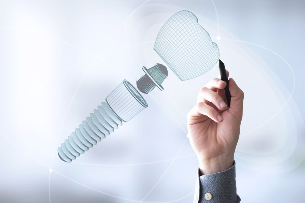 dental implants cost vs value