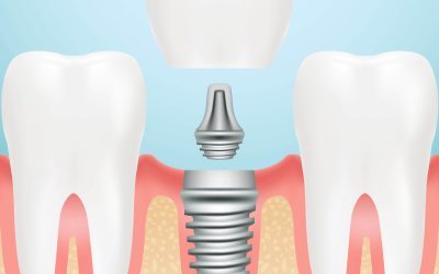 Dental Implants in Gordon: Your Complete Guide to Tooth Replacement