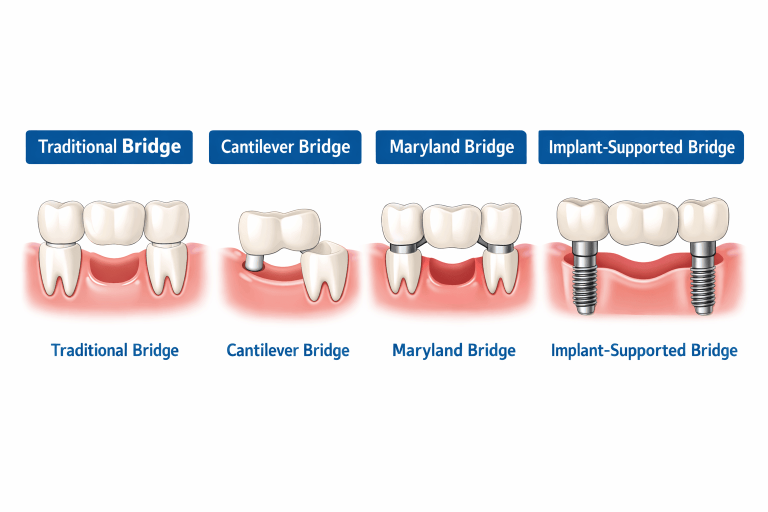 Comparison of dental bridge types in Gordon: Traditional, Cantilever, Maryland (resin-bonded), and Implant-Supported options