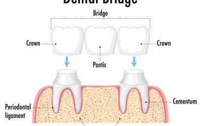 Dental Bridges in Gordon: Types, Cost Factors and How They Work