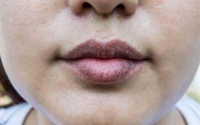 Dry Mouth (Xerostomia): Causes and How Your Dentist Can Help