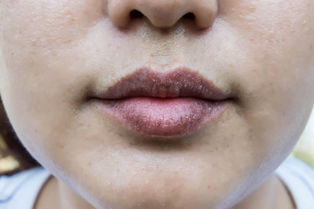 Dry Mouth (Xerostomia): Causes and How Your Dentist Can Help