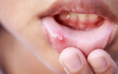 Mouth Ulcers: Causes, Treatment and When to See Your Dentist