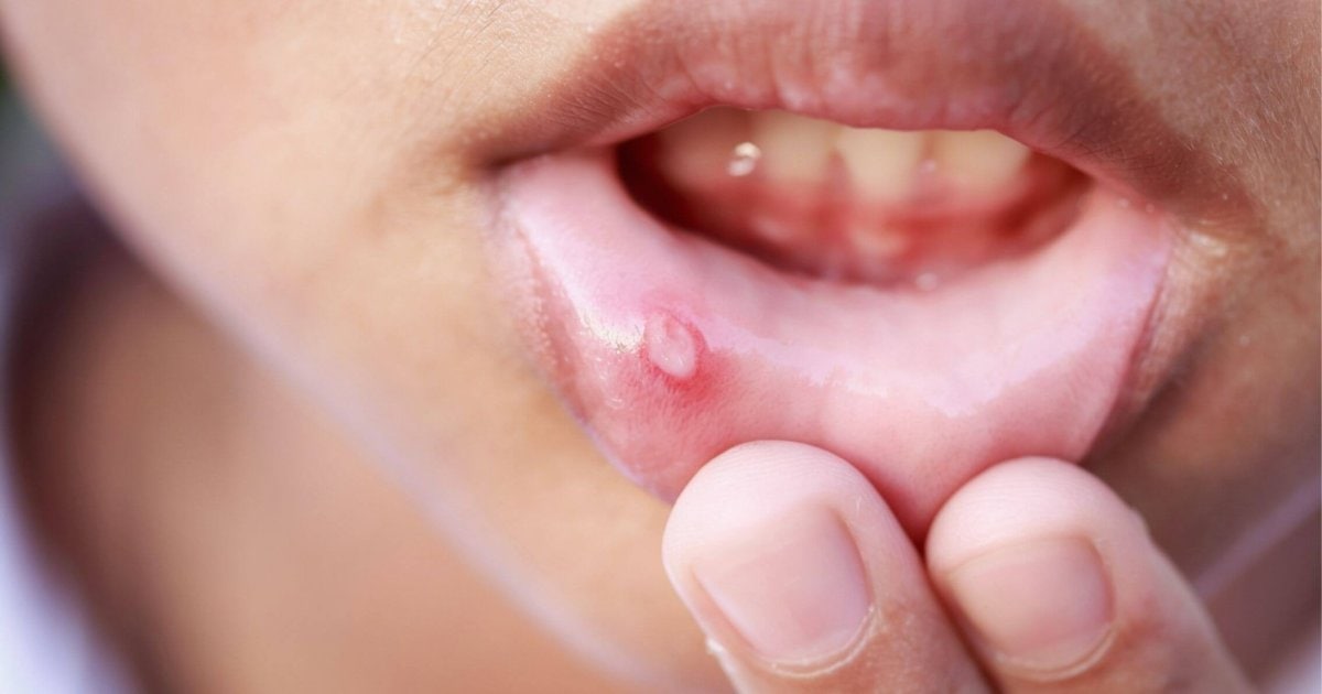Close-up of a mouth ulcer on the inner cheek showing white centre and red border in Gordon