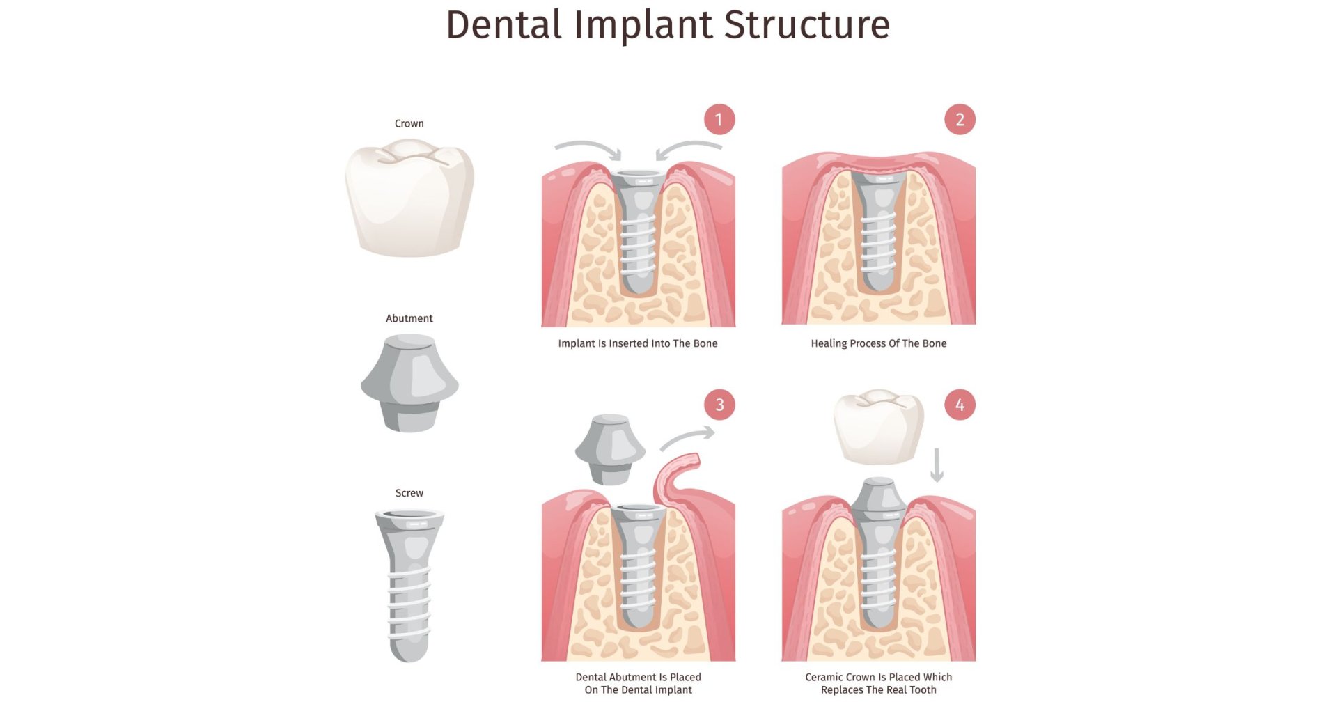Diagram of dental implant components affecting cost in Gordon