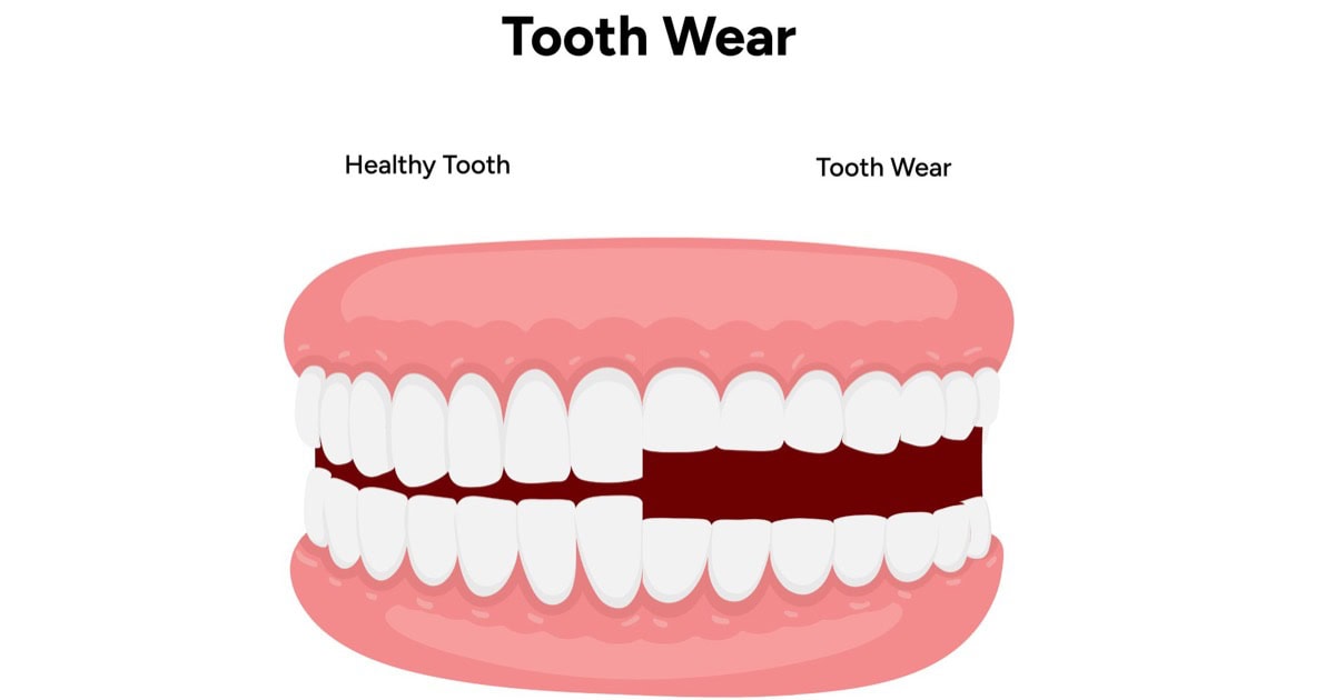 Diagram comparing healthy teeth with worn teeth in Gordon