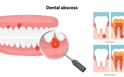 Tooth Abscess: What It Looks Like, Symptoms and Treatment