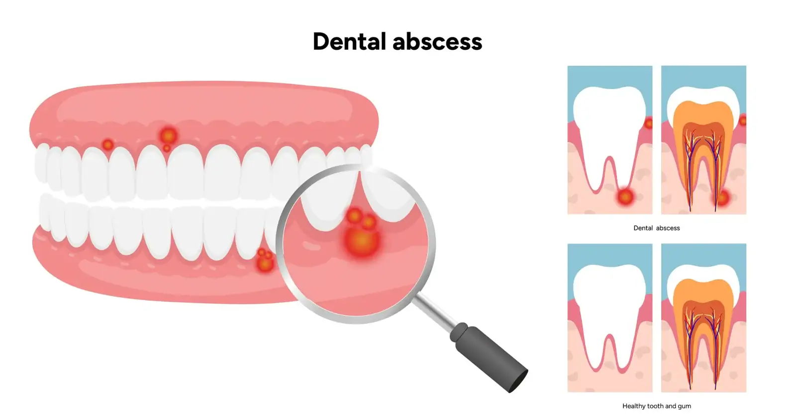 Diagram of a tooth abscess in Gordon